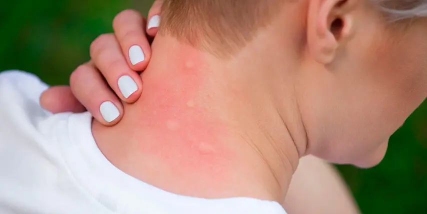 Evitar las picaduras de mosquitos es una de las batallas más comunes durante los meses de verano Evitar las picaduras de mosquitos es una de las batallas más comunes durante los meses de verano