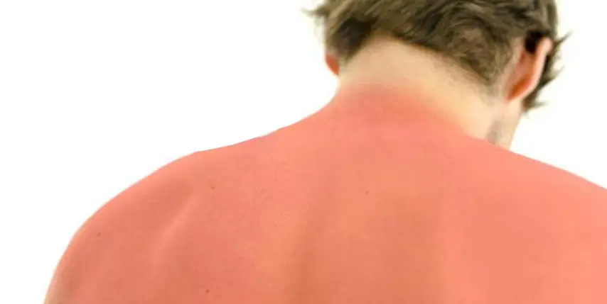 Quemaduras de sol: consejos para aliviarlas y sobrellevarlas mejor