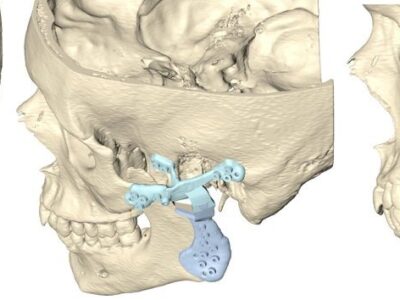 La reconstrucción de la articulación temporomandibular por un tumor requiere diseñar una prótesis a medida