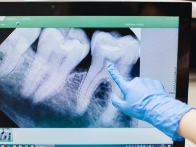 «Cada vez hay más evidencia de que la enfermedad periodontal, una inflamación crónica de las encías, puede estar relacionada con un mayor riesgo de sufrir infartos o accidentes cardiovasculares», doctor Carlos Mederos