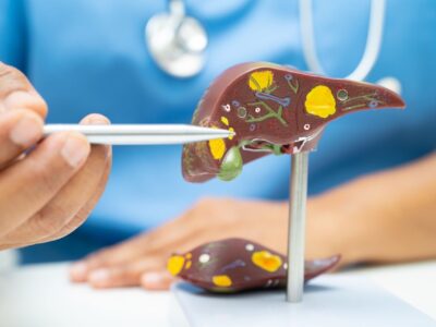 Dr. Alfredo Yoldi, endocrinólogo de Policlínica Gipuzkoa: Una nueva esperanza para el tratamiento del hígado graso
