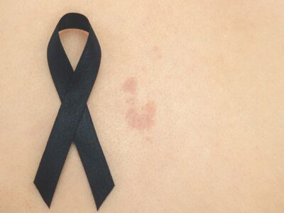 «Exponerse al sol sin protección puede tener consecuencias graves tanto a corto como a largo plazo», explica la dermatóloga Maribel Martínez