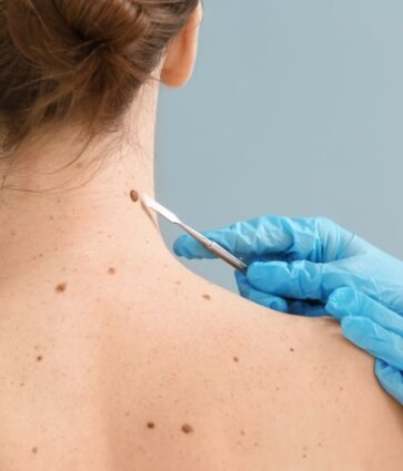 Dra. Ángela Estenaga, dermatóloga de Policlínica Gipuzkoa: «Hay que asumir que algunas pieles no pueden broncearse de forma saludable»