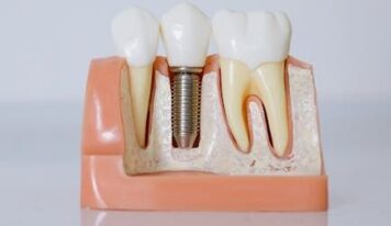 Dr. Javier Ortiz de Urbina: «El éxito de un implante dental depende en gran medida de la experiencia del profesional»