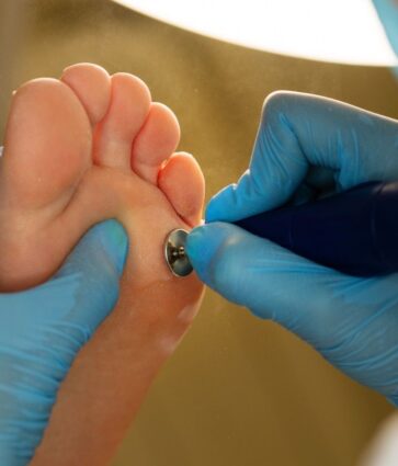 Los podólogos de la Unidad del Pie de Policlínica Gipuzkoa y Podoactiva ofrecen consejos para tratar el aumento de infecciones por hongos en los pies durante el verano