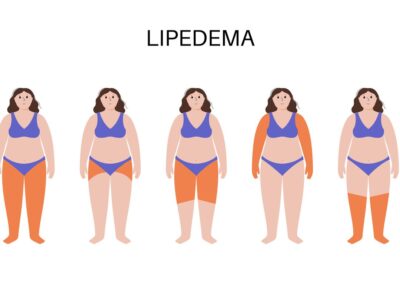Dolor, hinchazón y dificultad para caminar: así impacta el lipedema en la vida de las mujeres