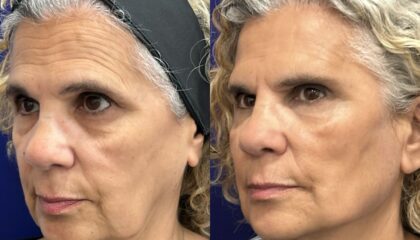 Global Face: nuevo protocolo integral del Dr. Ángel Martín para la recuperación de estructuras faciales, de la firmeza y elasticidad dérmica