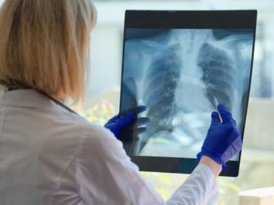 Dr. Aitor Asensi, neumológo de Policlínica Gipuzkoa: «Dejar de fumar es la medida más importante para frenar la evolución de la EPOC»