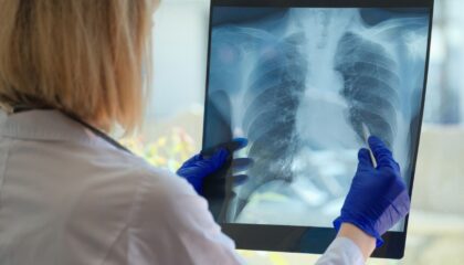 Dr. Aitor Asensi, neumológo de Policlínica Gipuzkoa: «Dejar de fumar es la medida más importante para frenar la evolución de la EPOC»