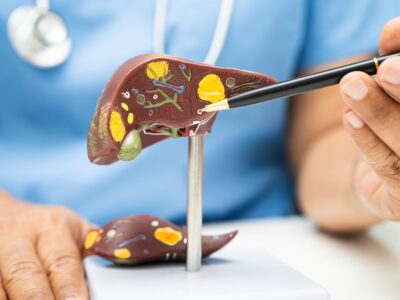 Dr. Juan Arenas, especialista en Aparato Digestivo de Policlínica Gipuzkoa: «La pérdida de peso es la clave para mejorar el hígado graso y el síndrome metabólico»