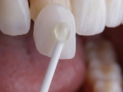 Instituto Volpe presenta Skin Finea®, carillas ultrafinas que preservan el diente propio al 100%