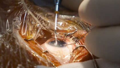 El codirector de FacoElche se somete en directo a la implantación bilateral de una lente diseñada con IA